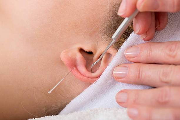 Auriculotherapy