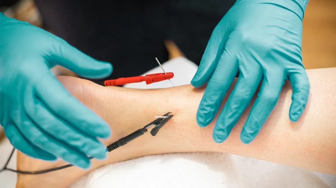 Electro Acupuncture